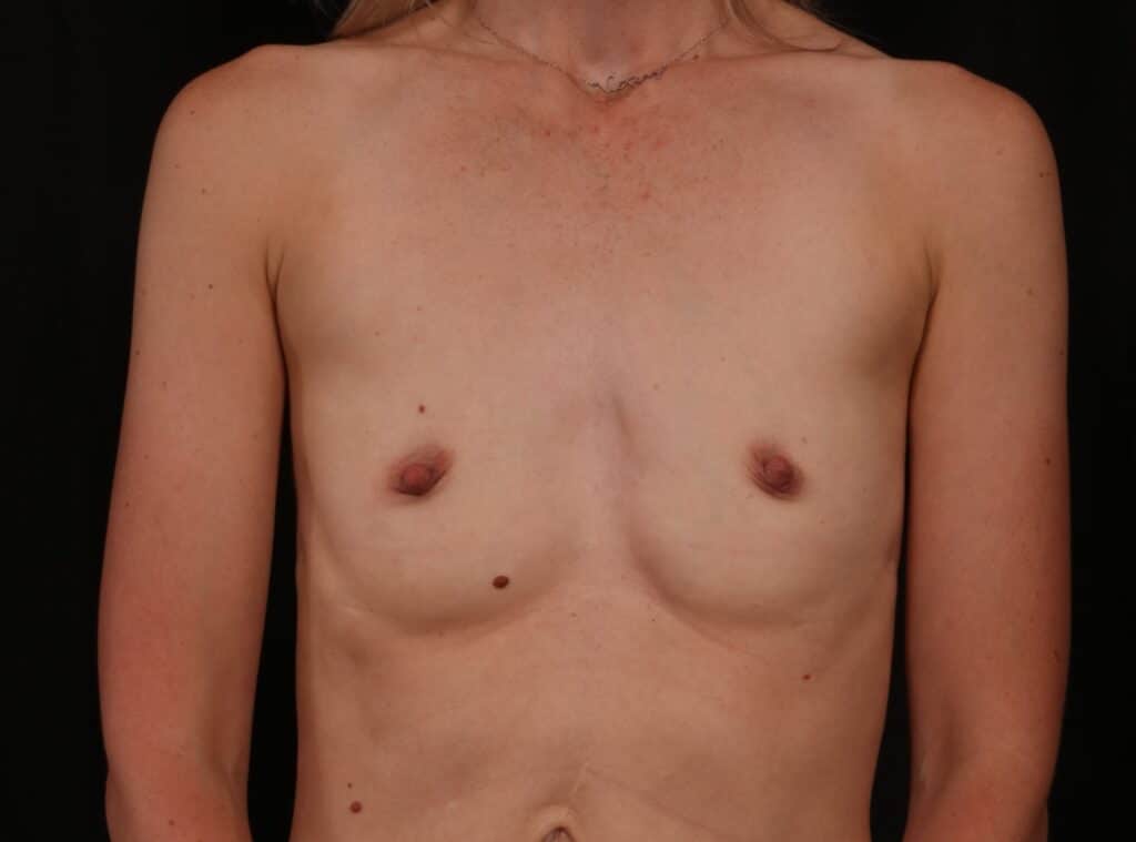 Before Image: Breast Augmentation - front