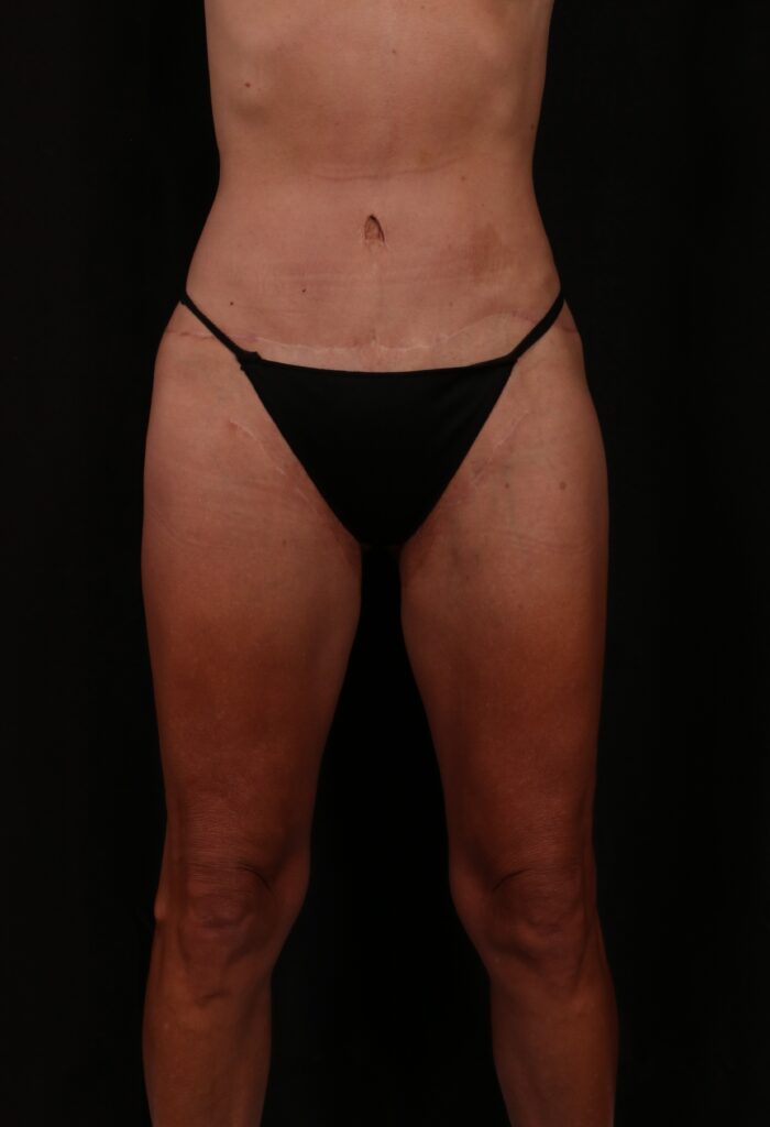 After Image: Lower Body Lift - front