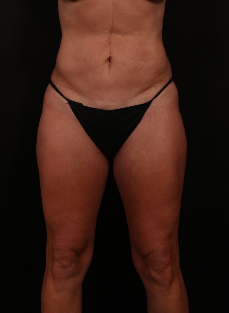 Before Image: Lower Body Lift - front