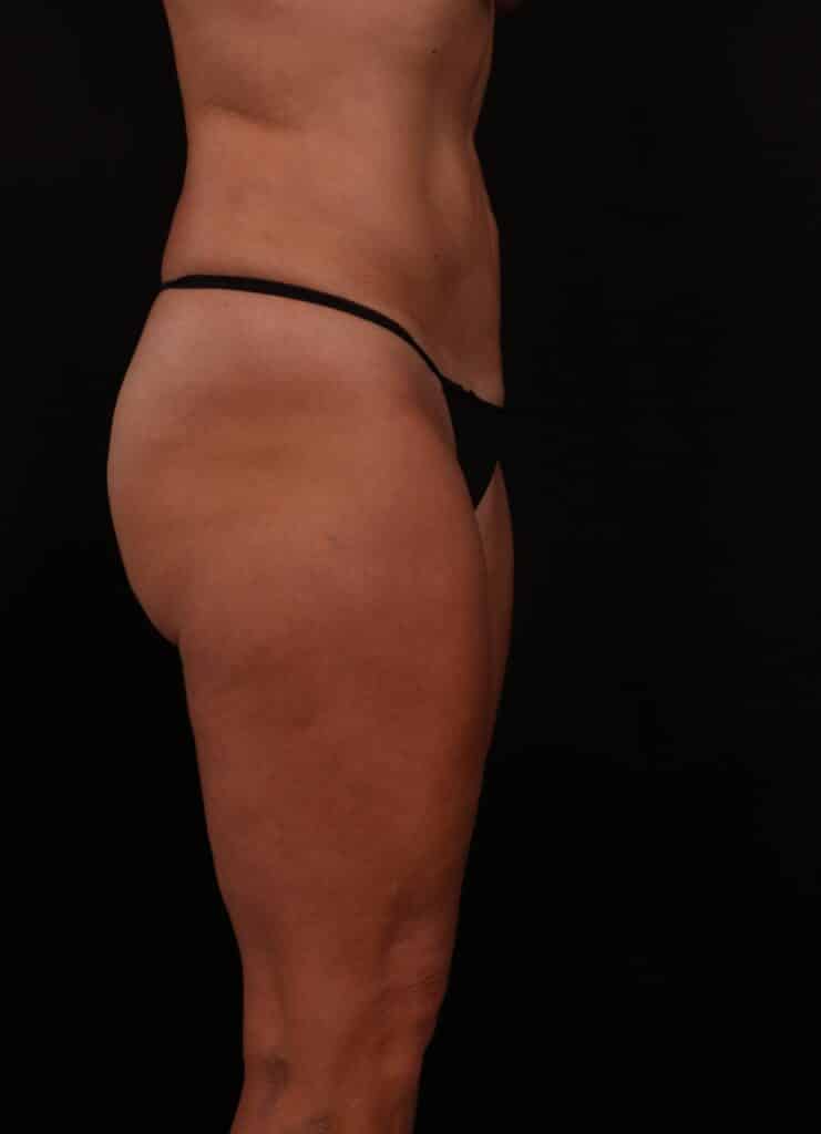Before Image: Abdominoplasty  - right-side