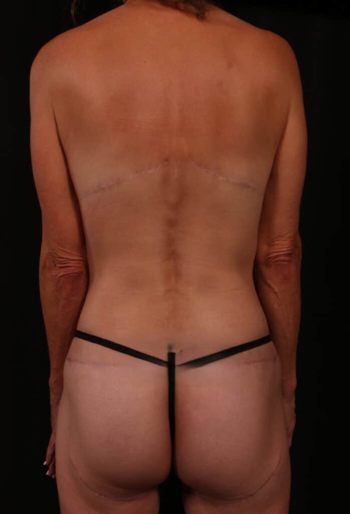 After Image: Bra Strap Excision - back