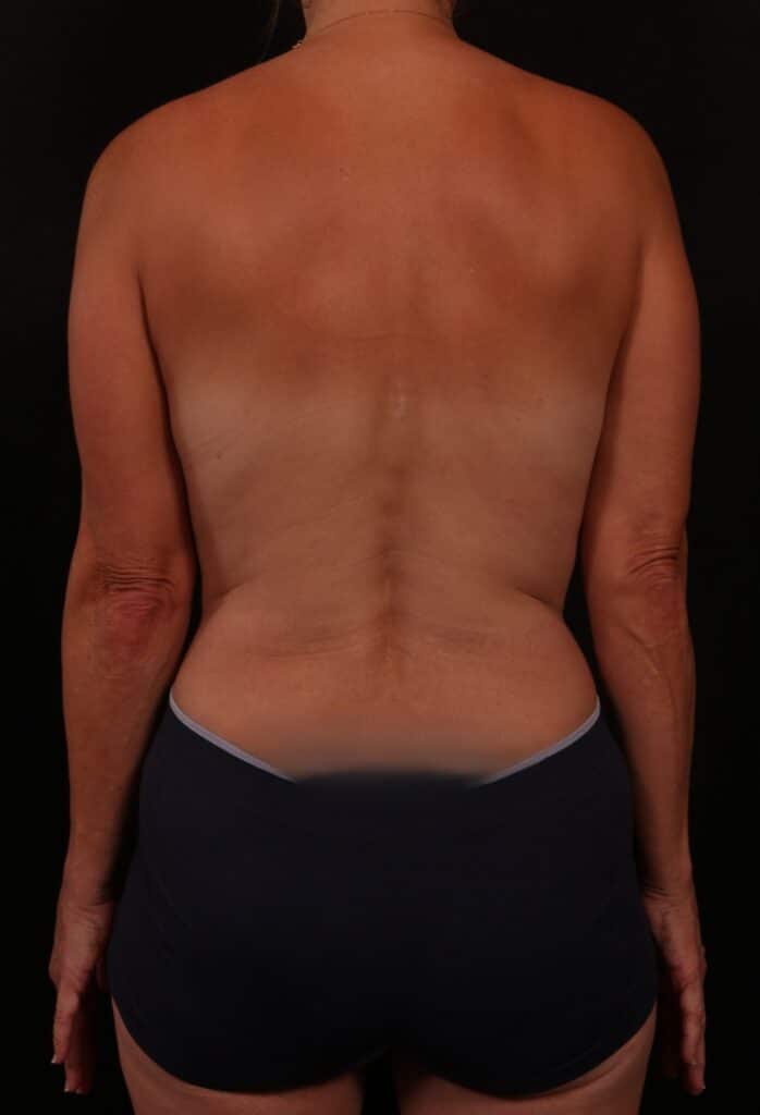 Before Image: Bra Strap Excision - back