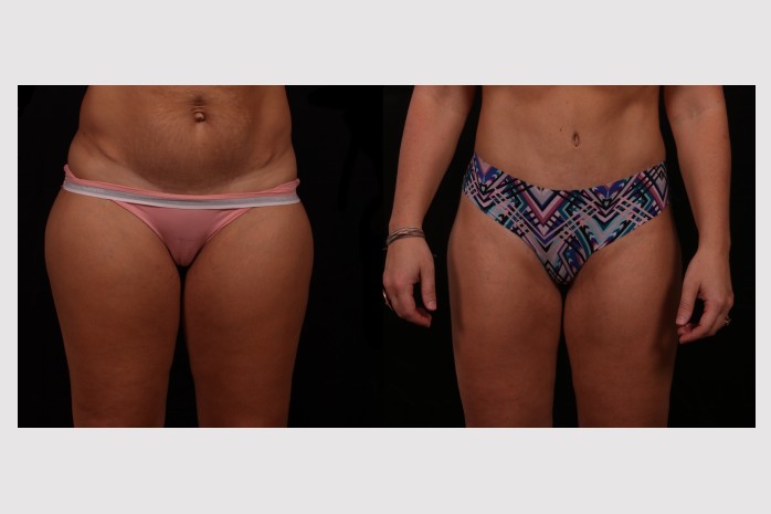 Before Image: Full Tummy Tuck - front