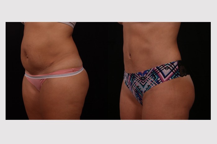 Before Image: Full Tummy Tuck - other