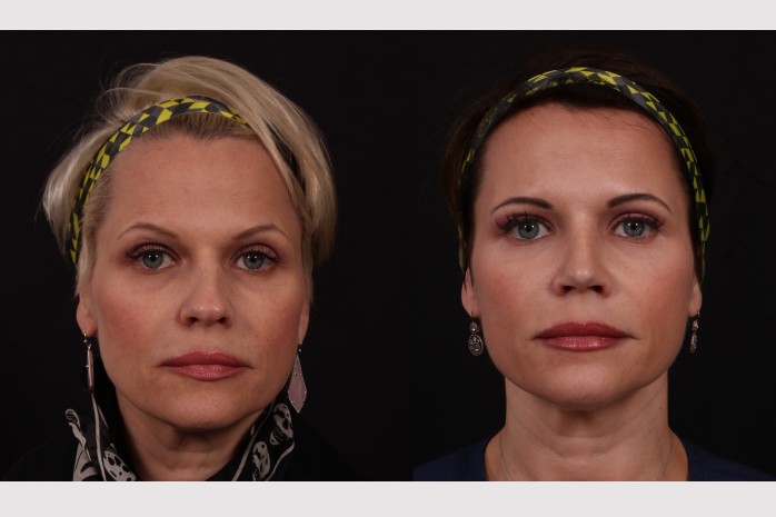 Before Image: Rhinoplasty - front