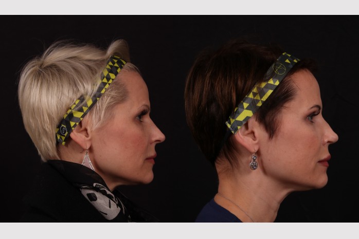 Before Image: Rhinoplasty - other