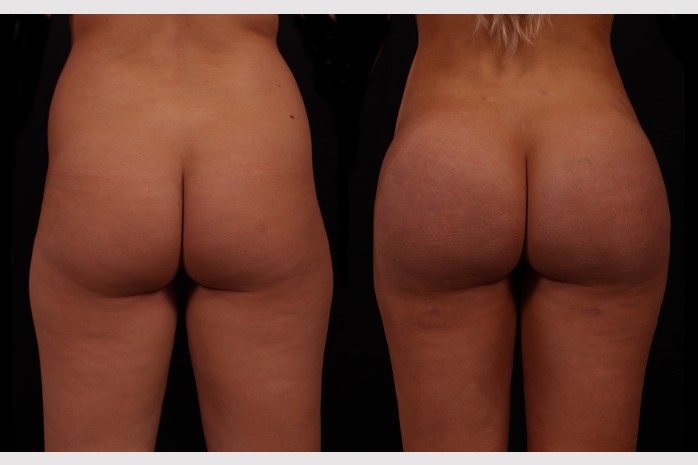 Brazilian Butt Augmentation (Butt Lift) .