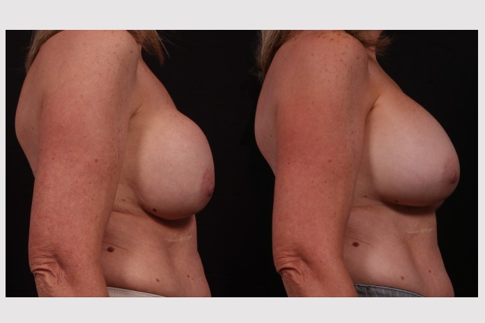 Before Image: Secondary Breast Surgery - other