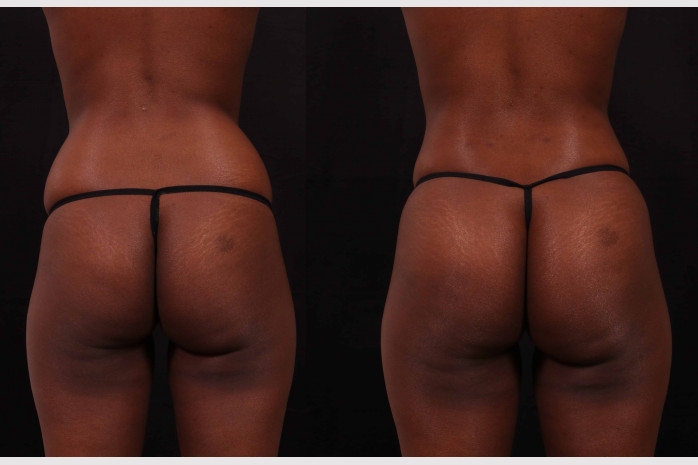 Brazilian butt lift nude - ðŸ§¡ Brazilian Butt Lift/Fat Transfer of Marc...