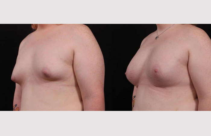 Augmentation transgender breast MTF Breast