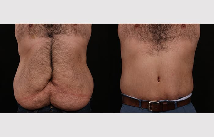 belt lipectomy
