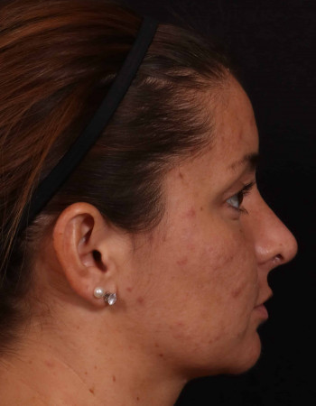 After Image: Rhinoplasty - other