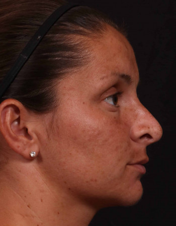 Before Image: Rhinoplasty - other