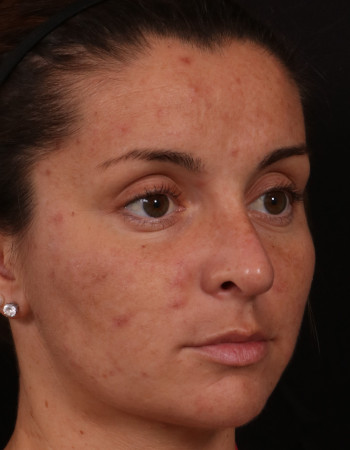 After Image: Rhinoplasty - front