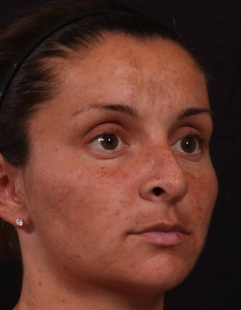 Before Image: Rhinoplasty - front