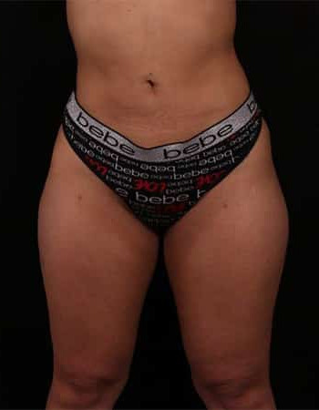 After Image: Liposuction - front