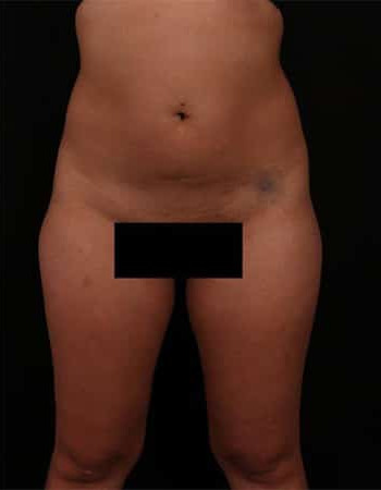 Before Image: Liposuction - front