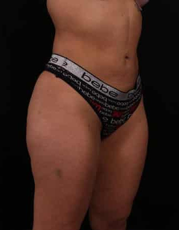 After Image: Liposuction - right-front-oblique