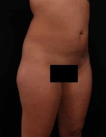Before Image: Liposuction - right-front-oblique