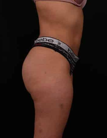 After Image: Liposuction - other