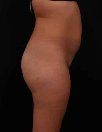 Before Image: Liposuction - other