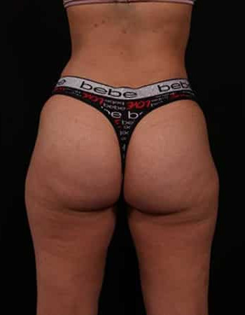 After Image: Liposuction - back