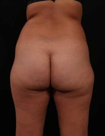Before Image: Liposuction - back