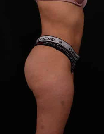 After Image: Brazilian Butt Lift - other