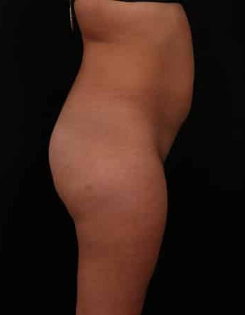 Before Image: Brazilian Butt Lift - other