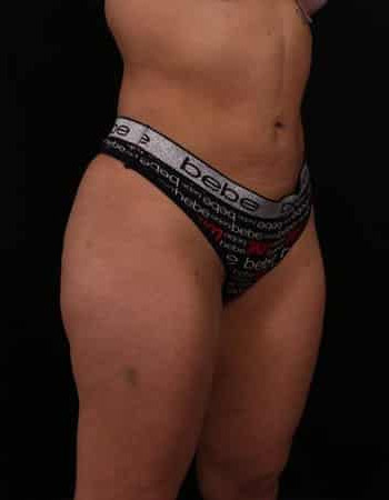 After Image: Brazilian Butt Lift - right-front-oblique