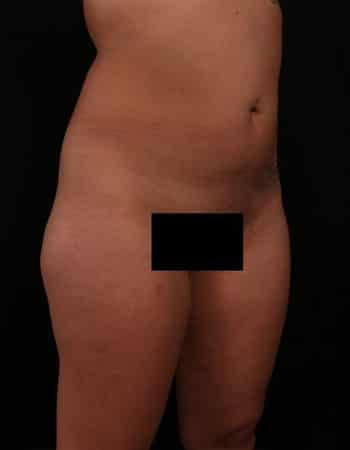 Before Image: Brazilian Butt Lift - right-front-oblique
