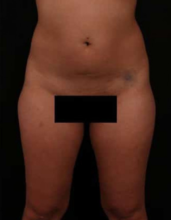 Before Image: Brazilian Butt Lift - front