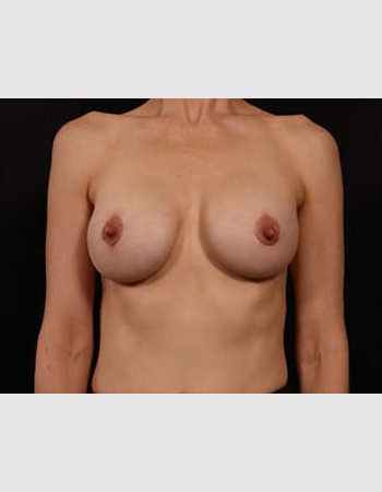 After Image: Breast Augmentation with Peri Areolar Lift - front