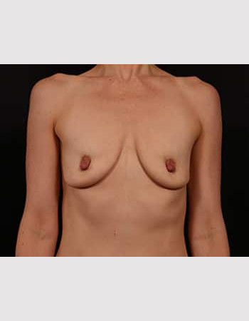 Breast Augmentation with Peri Areolar Lift