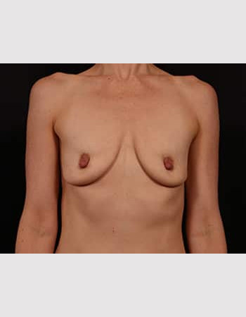 Before Image: Breast Augmentation with Peri Areolar Lift - front
