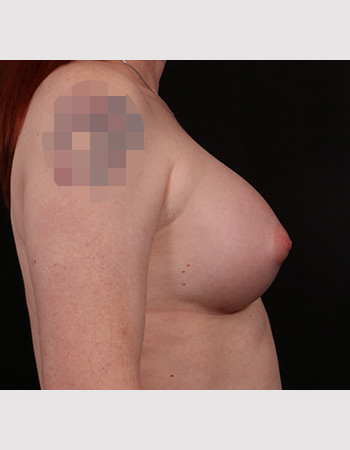 After Image: Transgender Breast Augmentation - other