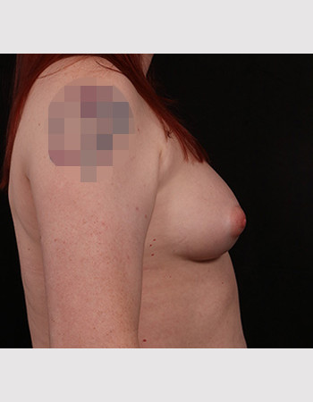 Before Image: Transgender Breast Augmentation - other