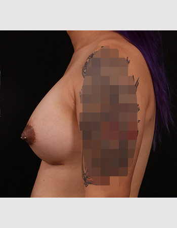 After Image: Transgender Breast Augmentation - other