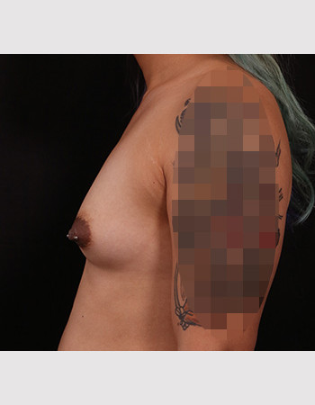 Before Image: Transgender Breast Augmentation - other