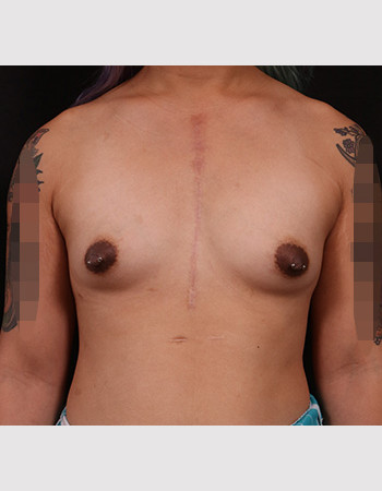 Before Image: Transgender Breast Augmentation - front