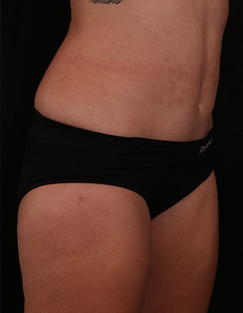 After Image: Tummy Tuck (Abdominoplasty) - right-front-oblique