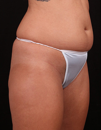 Before Image: Tummy Tuck (Abdominoplasty) - right-front-oblique