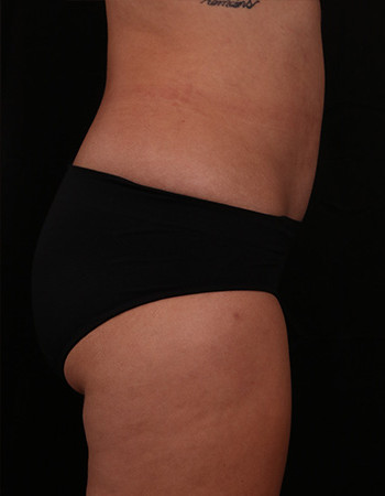 After Image: Tummy Tuck (Abdominoplasty) - right-side