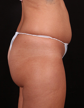 Before Image: Tummy Tuck (Abdominoplasty) - right-side