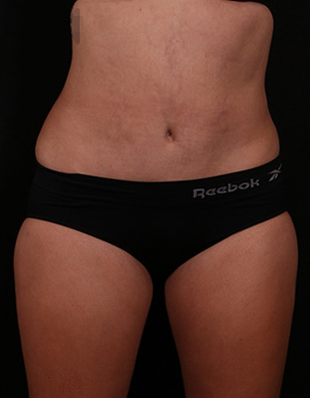 After Image: Tummy Tuck (Abdominoplasty) - front