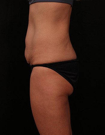 Before Image: Tummy Tuck (Abdominoplasty) - left-side