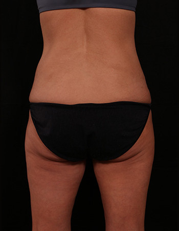 Before Image: Tummy Tuck (Abdominoplasty) - back