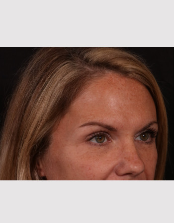 Facial Filler/Facial Fat Grafting