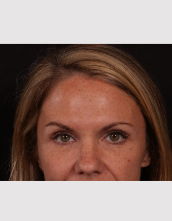 After Image: Facial Filler/Facial Fat Grafting - front