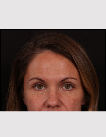 Before Image: Facial Filler/Facial Fat Grafting - front